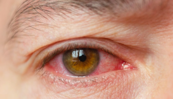 Homeopathic solutions for Eye Treatment